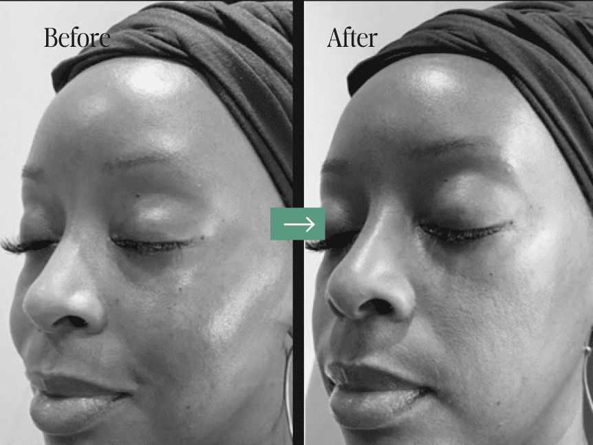 Laser Treatments Before and After Pictures Charleston County, SC